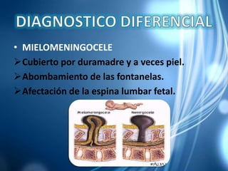 • MIELOMENINGOCELE
Cubierto por duramadre y a veces piel.
Abombamiento de las fontanelas.
Afectación de la espina lumbar fetal.
 