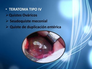 • TERATOMA TIPO IV
Quistes Ováricos
 Seudoquiste meconial
 Quiste de duplicación entérica
 
