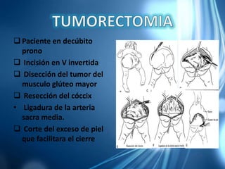 Paciente en decúbito
prono
 Incisión en V invertida
 Disección del tumor del
musculo glúteo mayor
 Resección del cóccix
• Ligadura de la arteria
sacra media.
 Corte del exceso de piel
que facilitara el cierre
 