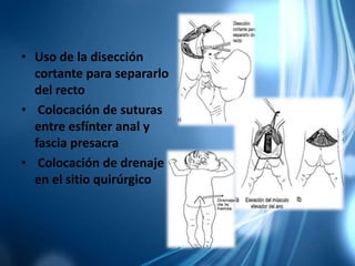 • Uso de la disección
cortante para separarlo
del recto
• Colocación de suturas
entre esfínter anal y
fascia presacra
• Colocación de drenaje
en el sitio quirúrgico
 