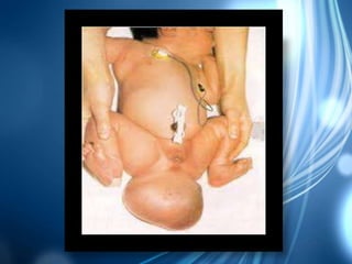 Teratoma sacrococcígeo