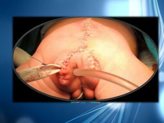 Teratoma sacrococcígeo