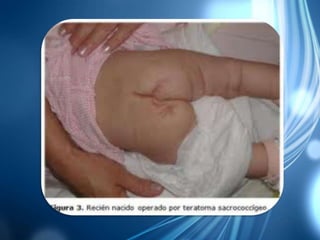 Teratoma sacrococcígeo