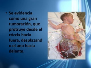 • Se evidencia
como una gran
tumoración, que
protruye desde el
cóccix hacia
fuera, desplazand
o el ano hacia
delante.
 