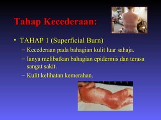 Tahap Kecederaan: TAHAP 1 (Superficial Burn) Kecederaan pada bahagian kulit luar sahaja. Ianya melibatkan bahagian epidermis dan terasa sangat sakit.  Kulit kelihatan kemerahan. 
