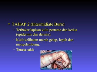TAHAP 2 (Intermidiate Burn) Terbakar lapisan kulit pertama dan kedua (epidermis dan dermis). Kulit kelihatan merah gelap, lepuh dan mengelembung. Terasa sakit . 