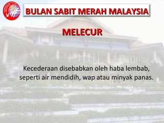 MELECUR Kecederaan disebabkan oleh haba lembab, seperti air mendidih, wap atau minyak panas. 
