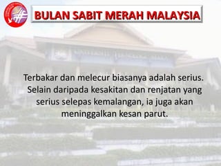 Terbakar Dan Melecur