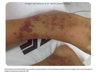 http://www.archivosdemedicina.com/medicina-de-familia/lupus-eritematosogeneralizadocaractersticasgeneralesinmunopatogeniay-
antgenos-derelevancia.php?aid=700
 