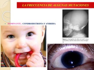 LA FRECUENCIA DE ALGUNAS MUTACIONES
 DOMINANTE.- CONDRODISTROFIA Y ANIRIDIA
 