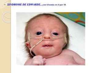  SINDROME DE EDWARDS…con trisomia en el par 18.
 