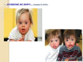  SINDROME DE DOWN… trisomia 21 (XXY)
 