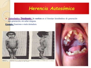 Herencia Autosómica
 Autosómica Dominante: Se manifiesta en el fenotipo heredándose de generación
tras generación, sin saltar ninguna.
Ejemplo: Enanismo o mala dentadura.
 