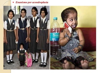  Enanismo por acondroplasia
 