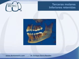 www.dentometric.com Dr. Enrique Sierra Rosales
Terceras molares
Inferiores retenidas
 
