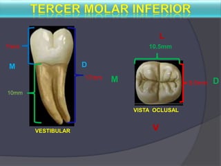 VESTIBULAR
VISTA OCLUSAL
DM
17mm M
L
v
7mm
D
10.5mm
9.5mm
10mm
 