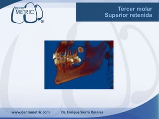 www.dentometric.com Dr. Enrique Sierra Rosales
Tercer molar
Superior retenida
 