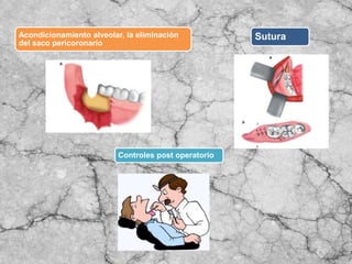 Acondicionamiento alveolar, la eliminación
del saco pericoronario
Sutura
Controles post operatorio
 