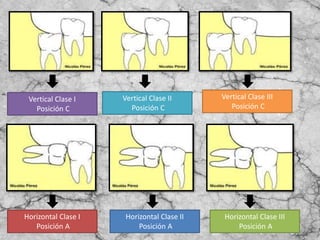 Vertical Clase I
Posición C
Vertical Clase II
Posición C
Vertical Clase III
Posición C
Horizontal Clase I
Posición A
Horizontal Clase II
Posición A
Horizontal Clase III
Posición A
 
