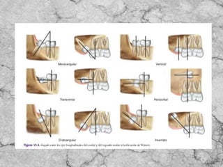 Terceros molares retenidos 