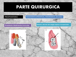 PARTE QUIRURGICA
PREOPERATORIO: RADIOGRAFIA (PERIAPICAL, PANORAMICA, OCLUSAL)
Anestesia idealmente troncular
Diéresis: elección del colgajo espesor mucoperiostio
 