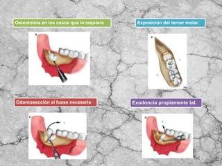 Osteotomía en los casos que lo requiera Exposición del tercer molar.
Odontosección si fuese necesario Exodoncia propiamente tal.
 