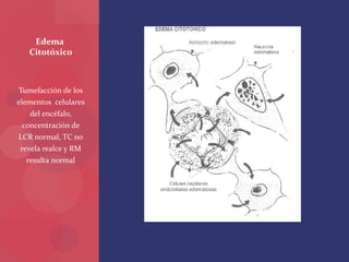 Tumefacción de los
elementos celulares
del encéfalo,
concentración de
LCR normal, TC no
revela realce y RM
resulta normal
Edema
Citotóxico
 