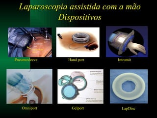 Laparoscopia assistida com a mão Dispositivos Pneumosleeve Hand port Intromit Omniport Gelport LapDisc 