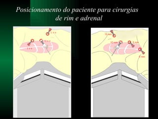 Posicionamento do paciente para cirurgias  de rim e adrenal 