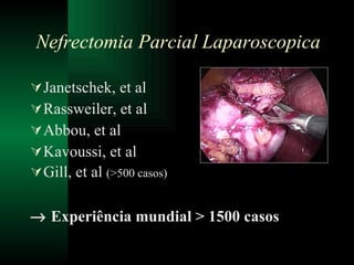 Janetschek, et al Rassweiler, et al Abbou, et al Kavoussi, et al Gill, et al  (>500 casos)    Experiência mundial > 1500 casos Nefrectomia Parcial Laparoscopica 