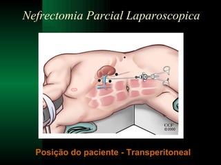 Nefrectomia Parcial Laparoscopica Posição do paciente - Transperitoneal 