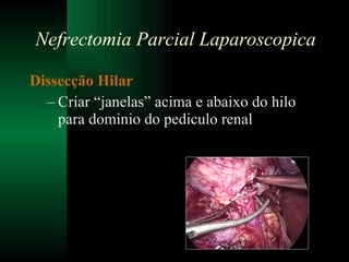 Dissecção Hilar Criar “janelas” acima e abaixo do hilo para dominio do pediculo renal Nefrectomia Parcial Laparoscopica 