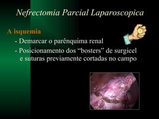 A isquemia  - Demarcar o parênquima renal - Posicionamento dos “bosters” de surgicel e suturas previamente cortadas no campo Nefrectomia Parcial Laparoscopica 