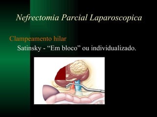 Clampeamento hilar Satinsky - “Em bloco” ou individualizado. Nefrectomia Parcial Laparoscopica 