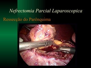 Ressecção do Parênquima Nefrectomia Parcial Laparoscopica 