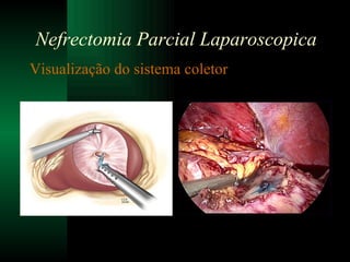 Visualização do sistema coletor Nefrectomia Parcial Laparoscopica 