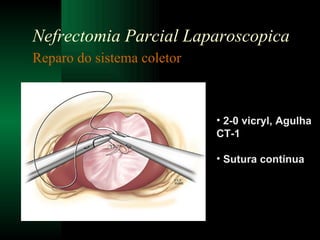 Reparo do sistema coletor  Nefrectomia Parcial Laparoscopica 2-0 vicryl, Agulha CT-1  Sutura contínua 