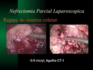 Reparo do sistema coletor   2-0 vicryl, Agulha CT-1 Nefrectomia Parcial Laparoscopica 