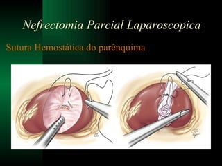 Sutura Hemostática do parênquima Nefrectomia Parcial Laparoscopica 