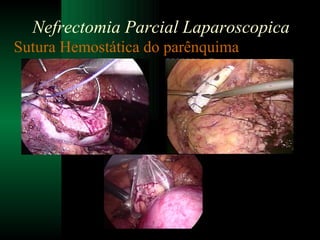 Sutura Hemostática do parênquima Nefrectomia Parcial Laparoscopica 