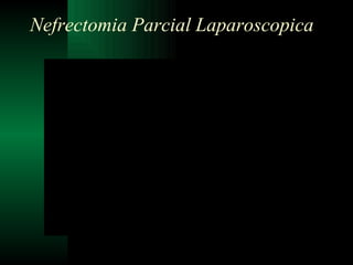 Nefrectomia Parcial Laparoscopica 