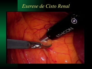 Exerese de Cisto Renal 