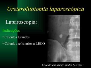 Ureterolitotomia laparoscópica Laparoscopia: Indicações Calculos Grandes Calculos refratarios a LECO Calculo em ureter medio (2,5cm) 