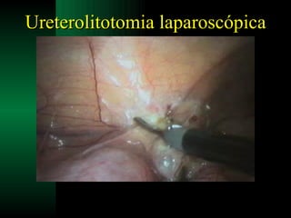 Ureterolitotomia laparoscópica 