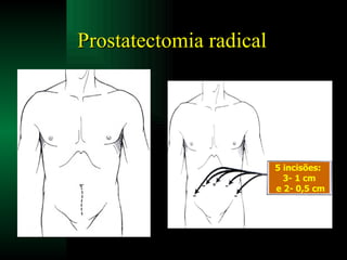 Prostatectomia radical 5 incisões:  3- 1 cm e 2- 0,5 cm 