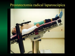 Prostatectomia radical laparoscópica 