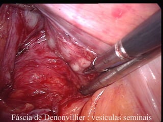 Fáscia de Denonvillier : vesículas seminais 