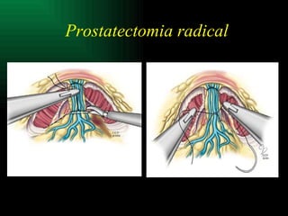 Prostatectomia radical 
