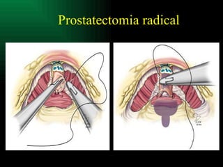Prostatectomia radical 