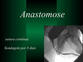 Anastomose sutura contínua Sondagem por 8 dias 